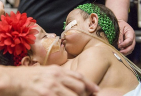 Conjoined twins separated at Texas Children`s Hospital